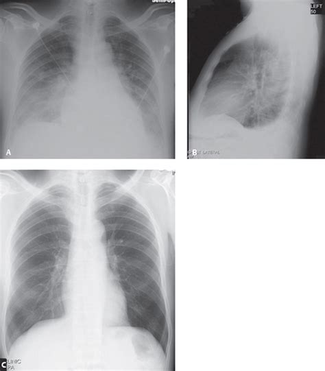 131 Increased Hydrostatic Pressure Edema Radiology Key