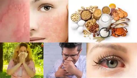 What Is An Allergy Definition Type Symptoms Diagnosis 2025