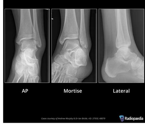 MODULE 4 ANKLE Flashcards Quizlet