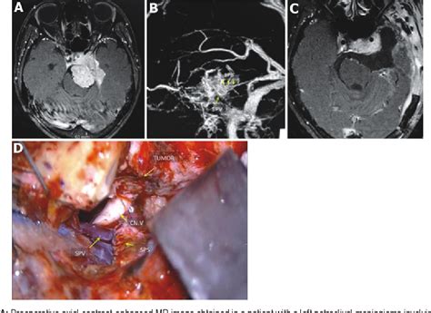 PDF Dural Incision In The Petrosal Approach With Preservation Of The