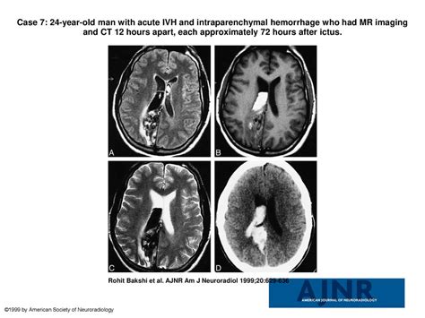 Case 7 24 Year Old Man With Acute IVH And Intraparenchymal Hemorrhage