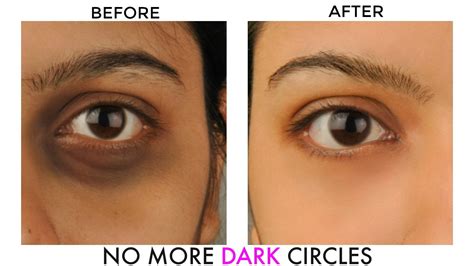 Dark Circles Treatment Dubai Laser Skin Care Clinic Dubai