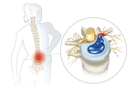 Herniated Disc Spinecare Singapore