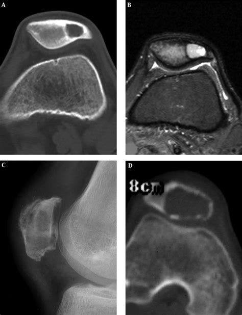 Patellar Chondroblastoma And Giant Cell Tumor Are Shown A And B A