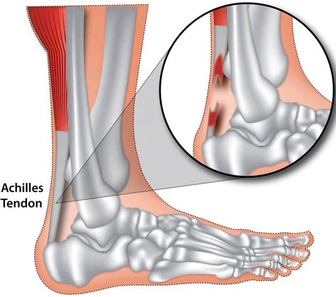 Achilles Tendon Bursitis