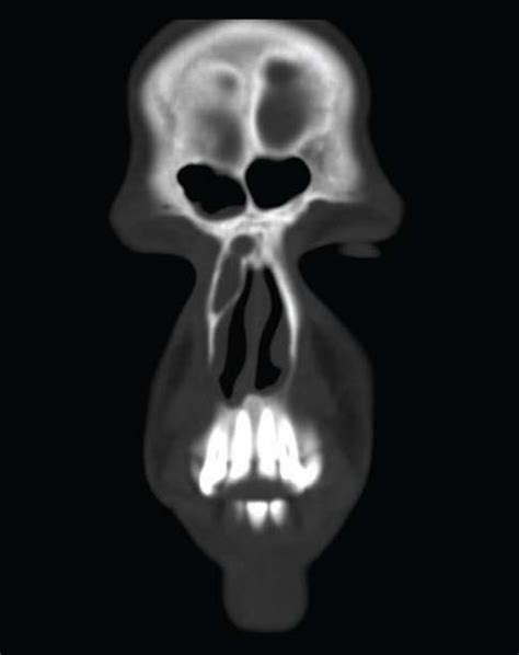 Ethmoid Air Cells On Skull