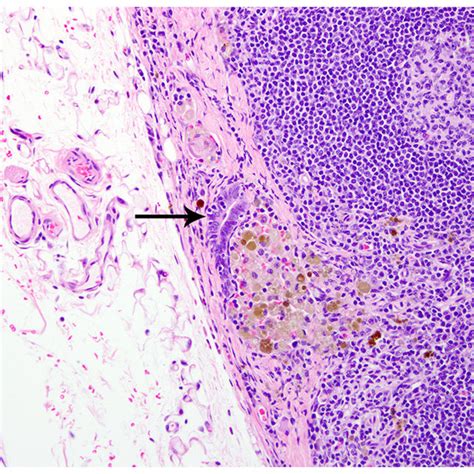 Pleural Endometriosis Lung Rhesus Macaque Endometriotic Glandular