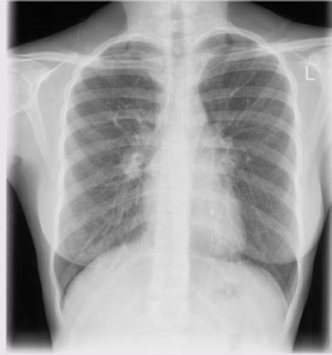 PA 525 TUBERCULOSIS Flashcards Quizlet