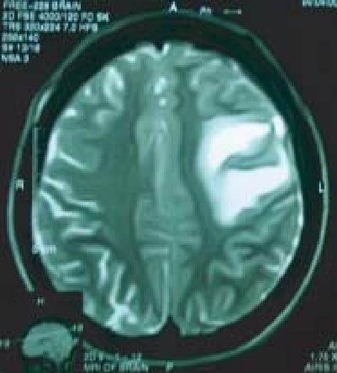 T2 Weighted Axial MRI Of The Brain Showing Hyper Intense Shadow In Left