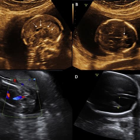 Ultrasound Imaging 2d Revealing Complete Agenesis Of Corpus Callosum Download Scientific