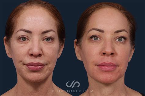 Laser Skin Resurfacing Before And After Pictures Case 2035 Los Angeles Ca Stoker Aesthetics