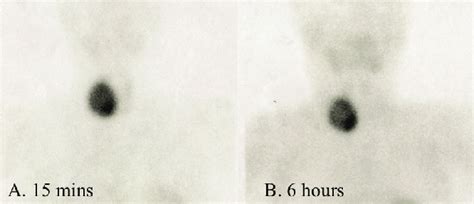 Technetium Tc 99m Sestamibi Scan Showing Increased Uptake In The