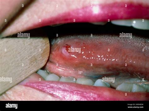 Leiomyosarcoma On Tongue Close Up Of The Mouth Of A Year Old Woman