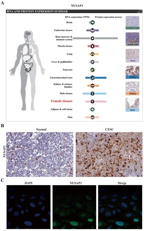 Expression Of Nusap At Mrna And Protein Levels In Cervical Cancer