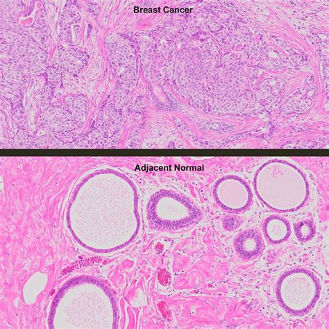 Human Breast Cancer With Erprher2 And Normal Matched Pair Tissue