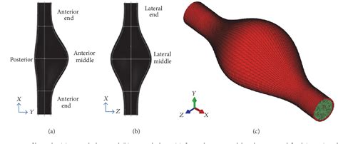 Figure From Fluid Structure Interaction In Abdominal Aortic Aneurysm