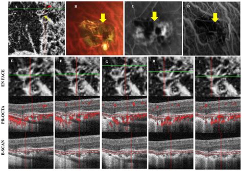 Frontiers Perforating Scleral Vessels Adjacent To Myopic Choroidal Neovascularization Achieved