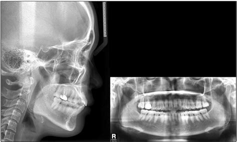 Posttreatment Cephalometric And Panoramic Radiographs Download