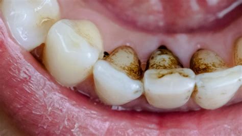 Black Stains On Teeth: Causes and Treatment in Bassendean