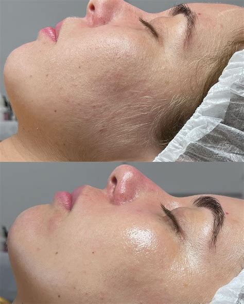 O Dermaplaning é uma das minhas técnicas preferidas Já contei para