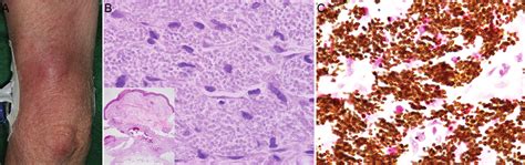 Clinical Features And Histopathology A Indurated Erythema At The