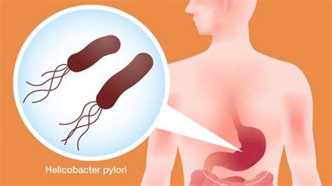 H Pylori O Que E Como Tratar Essa Bact Ria Op Es Naturais