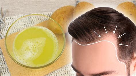 How To Stop Hair Loss Naturally Youtube