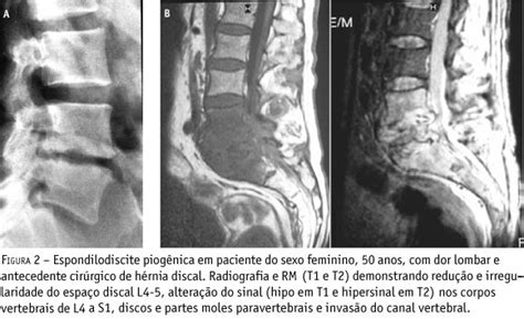 Scielo Brasil Diagnóstico Por Imagem Nas Espondilodiscites