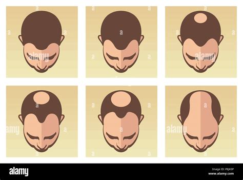 Una Ilustración Vectorial Mostrando Las Diferentes Etapas De La Pérdida De Cabello Masculina