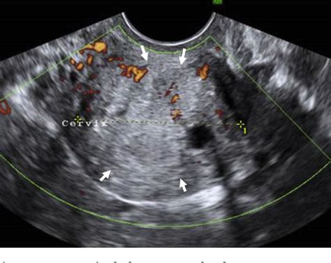 Figure 1 From Magnetic Resonance Imaging Of Adenoma Malignum Of The