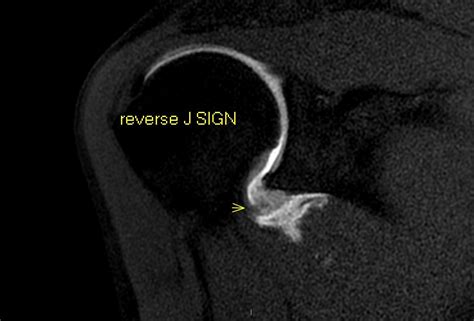 Gagl Lesion With “reverse J Sign” Image