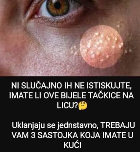 Ni Slu Ajno Ih Ne Istiskujte Imate Li Ove Bijele Ta Kice Na Licu