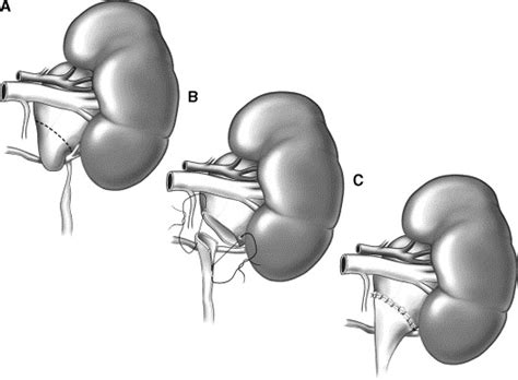 Open Pyeloplasty Atlas Of The Urologic Clinics Of North America