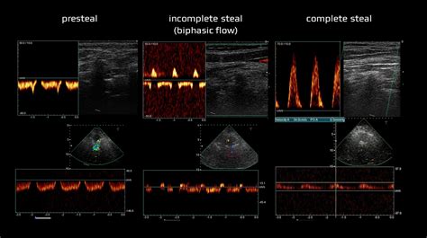 Subclavian (vertebral) steal syndrome | STROKE MANUAL