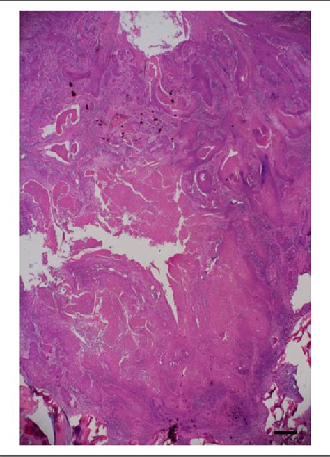 Figure 14 From Endoscopically Assisted Marginal Mandibulectomy Using An