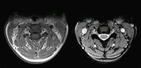 Normal Cervical Spine Axial Mri | Hot Sex Picture