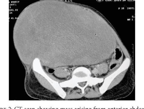 Figure 2 From Giant Desmoid Tumor Of The Anterior Abdominal Wall In A Young Female A Case