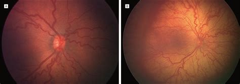 The International Classification Of Retinopathy Of Prematurity Revisited Neonatology Jama