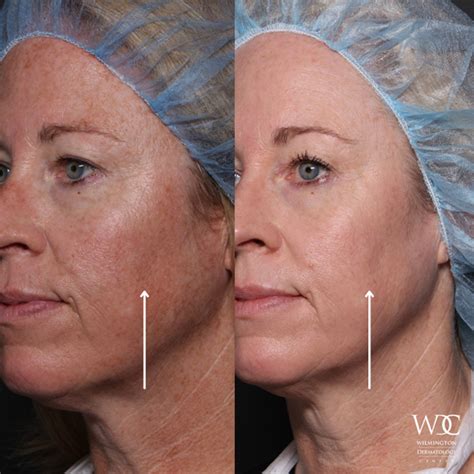 Tetra Co2 Cool Peel Laser Wilmington Dermatology Center