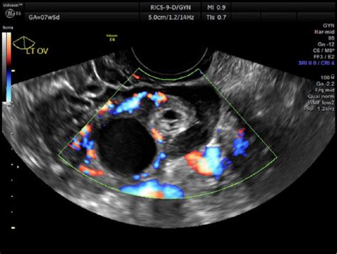 Ectopic Pregnancy Ultrasound 8 Weeks