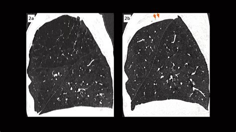 Severe Emphysema Treated With Endobronchial Valves