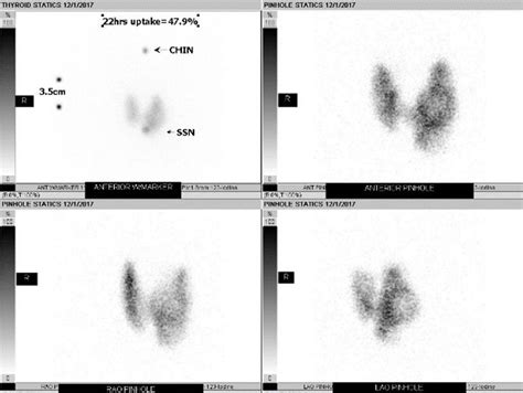 Multiple Views Of Thyroid Gland Hours After Radioactive Iodine