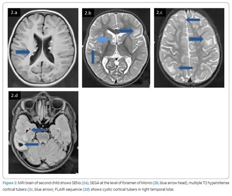 Intriguing Tuberous Sclerosis Clinico Radiological Mismatch Infact