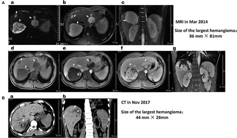 Cavernous Hemangioma Liver Ultrasound