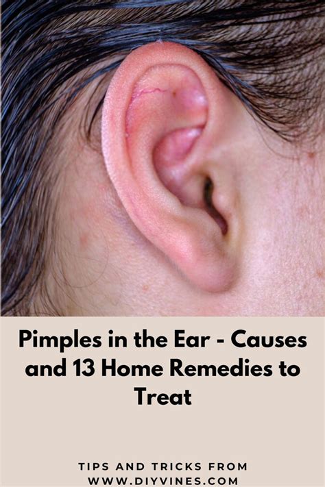 Pimples In The Ear Causes And 13 Home Remedies To Treat Ear Pimple Pimples Pimples Remedies