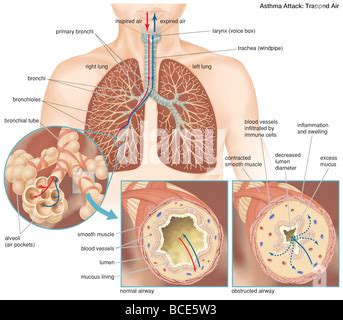 Asthma Pathology An Illustration Of Lungs With A Normal Airway Left