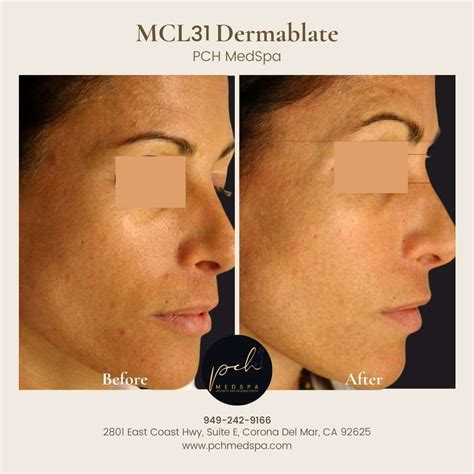 Laser Skin Resurfacing Newport Beach Orange County CA