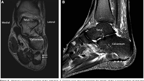 Figure 2 From Ultrasound Guided Hydrodissection For Baxter S Neuropathy Secondary To Plantar