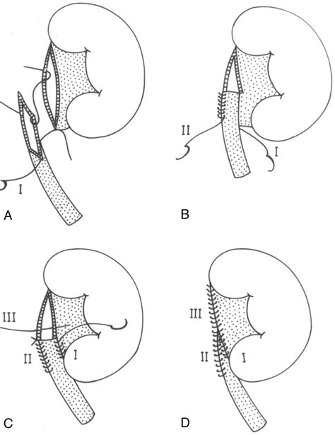 Steps To Reduce Operative Time In Laparoscopic Dismembered Pyeloplasty For Moderate To Large