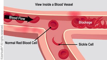 Sickle Cell Pain Hot Sex Picture